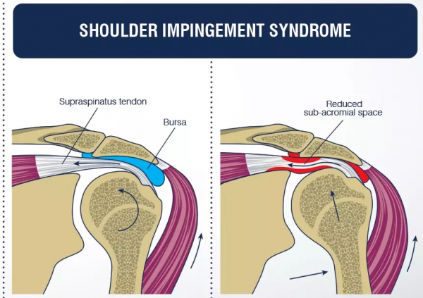 What is Shoulder Impingement?