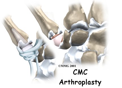 Artificial Joint Replacement of the Thumb - STAR Physical Therapy's Guide