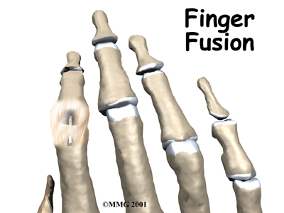 Finger Fusion Surgery - STAR Physical Therapy's Guide