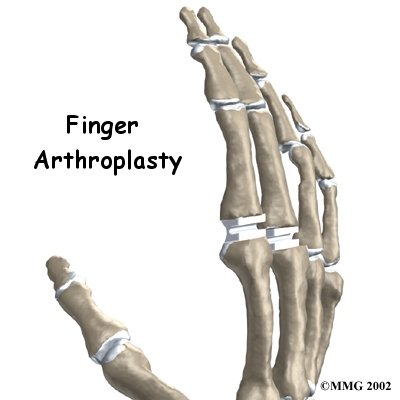 Artificial Joint Replacement of the Finger - STAR Physical Therapy's Guide